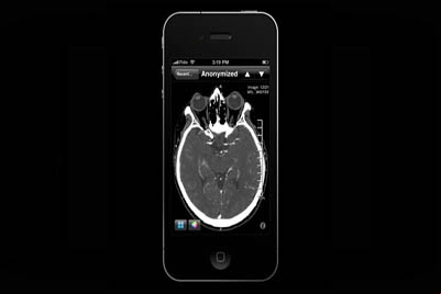 Aplicativo para iphone pode diagnosticar derrames cerebrais
